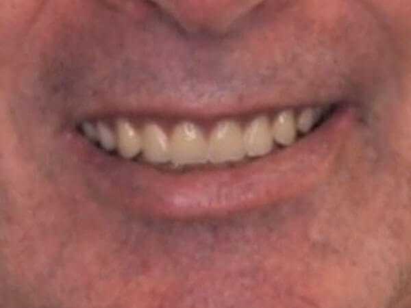 after picture of a man's corrected and whitened smile