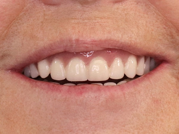 after picture of a woman's corrected and whitened smile
