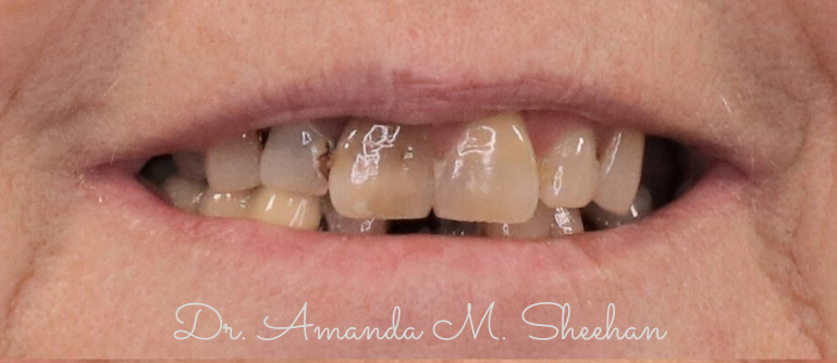 before picture of a woman's misshaped and yellowed teeth