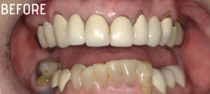 before picture of a man's yellowed and crooked teeth