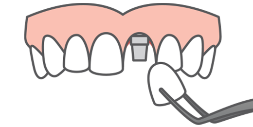 single tooth implant solution.