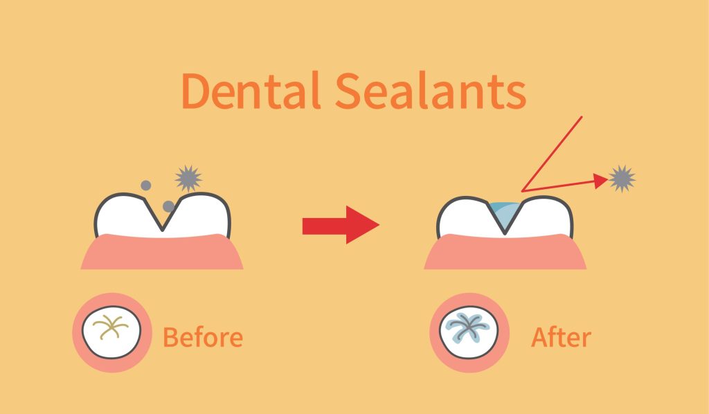 dental sealants before and after