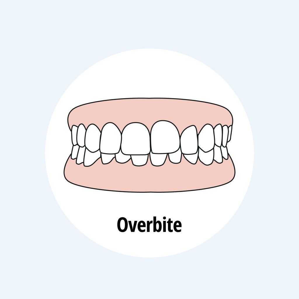 overbite