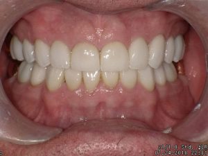 After treatment at Oakland Family Dental