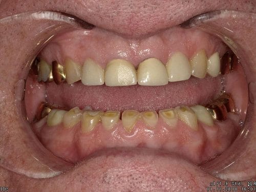 Before treatment at Oakland Family Dental