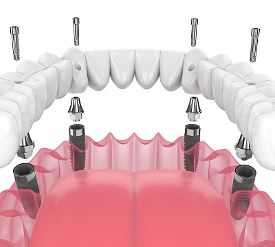 All on 4 dental implants