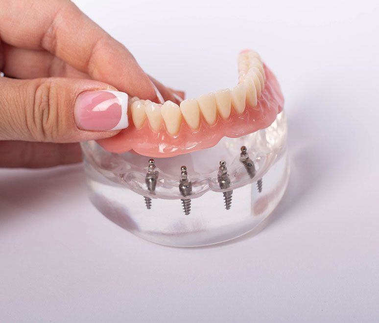 dental implants