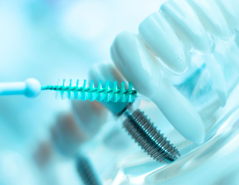 cleaning dental implants