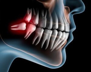 wisdom tooth removal