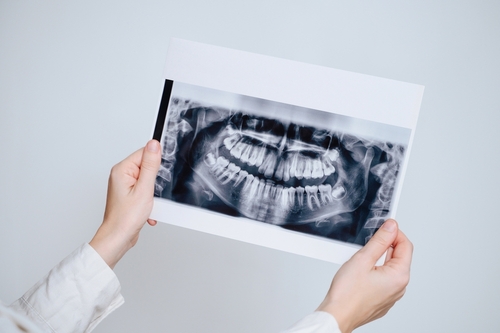 panoramic dental x-ray